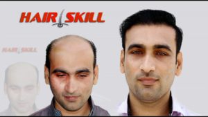 Hair replacement center in Pakistan