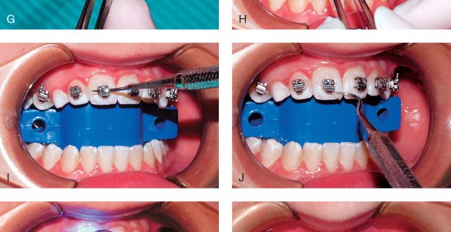 Why Do I Need Braces Activation?